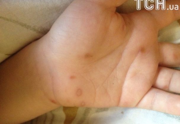 У київському дитячому садку виявлено небезпечний вірус