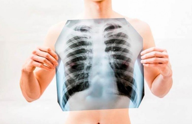 ВОЗ предупредил о страшной эпидемии легочной чумы