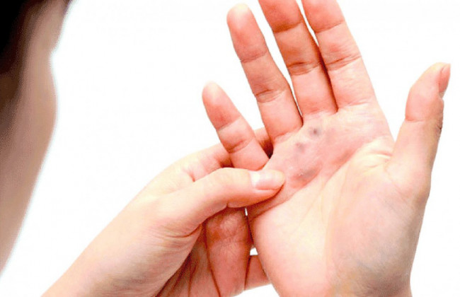 В зоне риска — дети: эта инфекция передается через одежду и игрушки