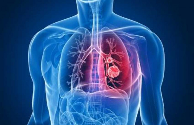 Эти симптомы говорят о раке легких