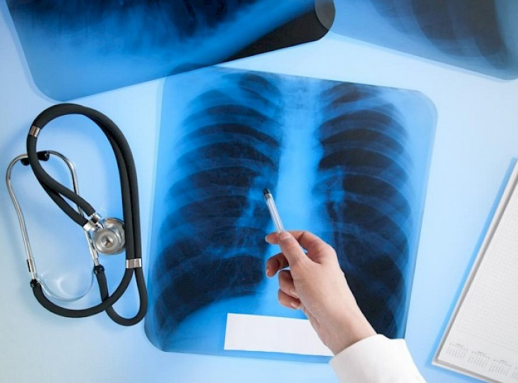 Больных туберкулезом будут лечить по-новому: что нужно знать