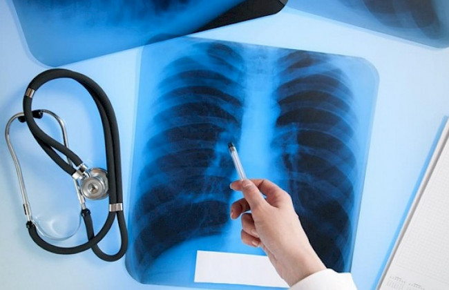 Больных туберкулезом будут лечить по-новому: что нужно знать