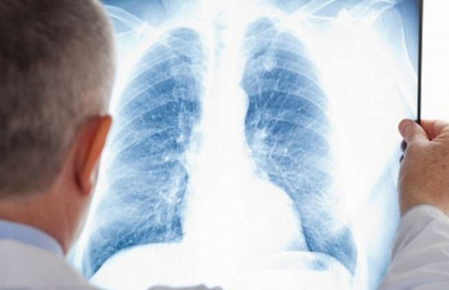 Как выглядят легкие курильщика и здорового человека: медики показали