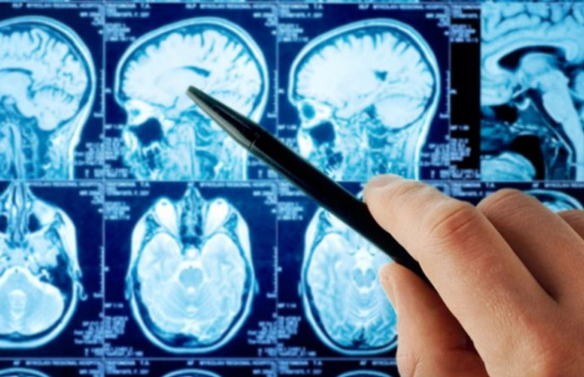 Назвали семь ранних симптомов опухоли мозга