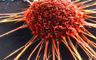 Антибиотики и противогрибковые: найден способ убить рак на последней стадии