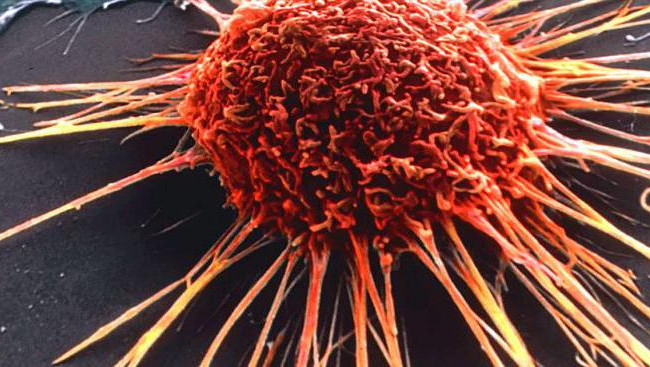 Антибиотики и противогрибковые: найден способ убить рак на последней стадии