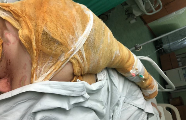 Волосы дымились: появилось подробности от облитой кислотой активистки