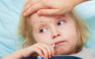 Епідемія кору в Україні: в МОЗ оприлюднили шокуючі цифри