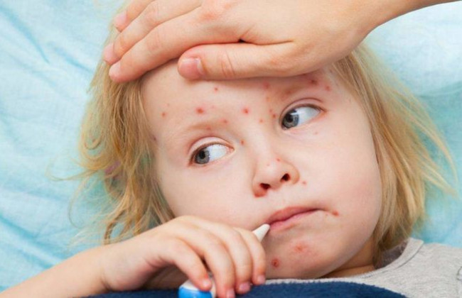 Епідемія кору в Україні: в МОЗ оприлюднили шокуючі цифри
