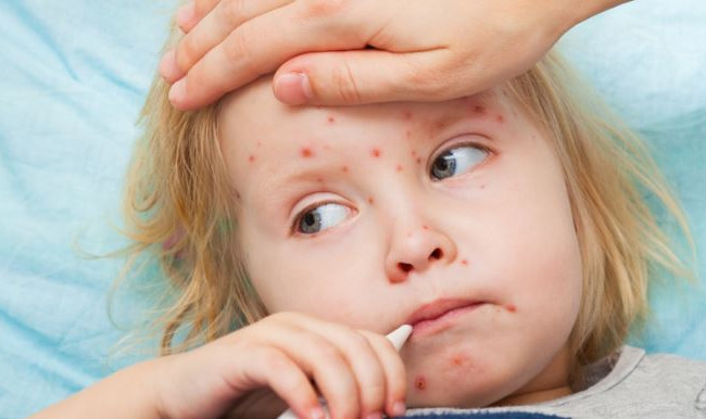 Эпидемия кори: новый очаг появился в Одесской области