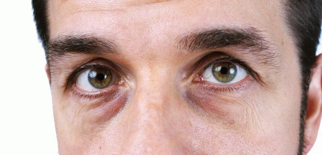 Круги под глазами — почему возникают и как их лечить