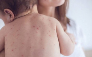 Трагедия в Ровно: 3-месячная девочка умерла от кори