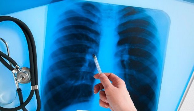 Українці можуть безкоштовно перевіритися на туберкульоз: онлайн-тест