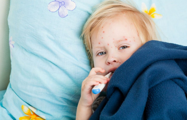 Украина в первой пятерке стран по заболеваемости корью