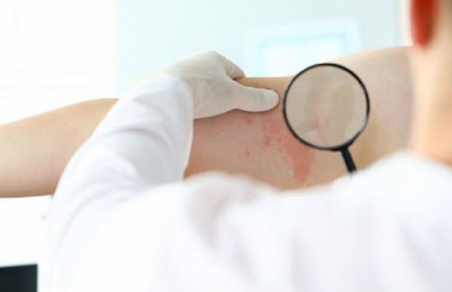 Сыпь и покраснения на коже: стало известно о новых симптомах коронавируса