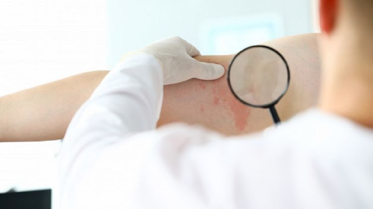 Сыпь и покраснения на коже: стало известно о новых симптомах коронавируса