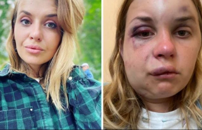 Избитая девушка в поезде Мариуполь—Киев рассказала о своем самочувствии