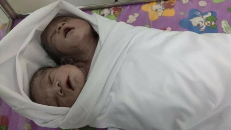 Уникальный случай: в Мьянме родился ребенок с двумя головами, фото