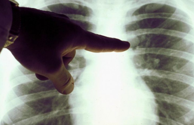 Назвали лучший способ диагностики пневмонии при коронавирусе