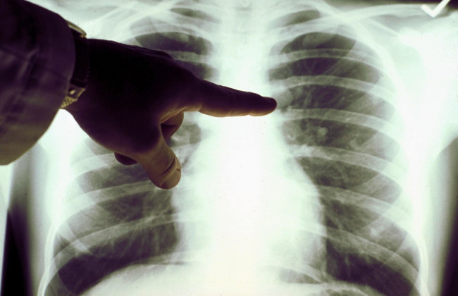 Почему развивается рак легких у некурящих:  медики назвали главные причины