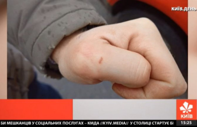 У Києві біля станції метро «Політехнічний інститут» продавець шаурми покусав оператора телеканалу «Київ»