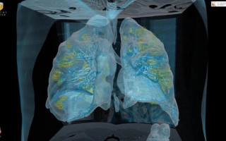 Вирусные частицы в легких: названа главная причина смерти от СOVID-19