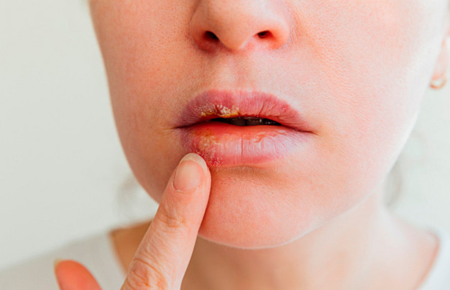 Клин клином: герпес способен снизить вероятность заболеть COVID