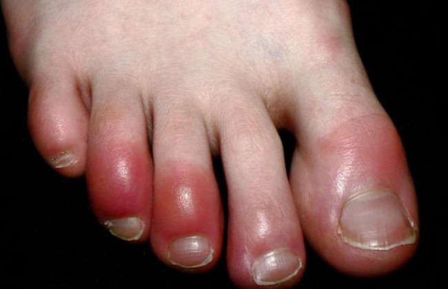 «Обморожение» пальцев: выявили необычный симптом коронавируса
