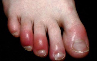 «Обморожение» пальцев: выявили необычный симптом коронавируса