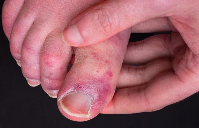 Страдают дети и подростки: что такое симптом «ковидных пальцев» при коронавирусе