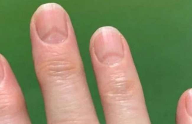 Обнаружили неожиданные признаки перенесенного коронавируса