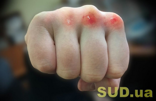 Мешала уехать: в Киеве мужчина на Mercedes ударил 9-летнюю девочку