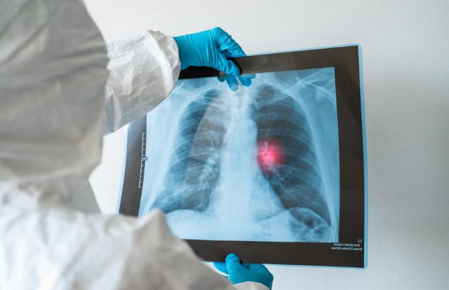 Эпидемиолог предупредила о увеличении риска инфаркта и инсульта у переболевших COVID-19