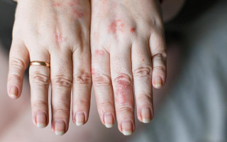 Врачи рассказали о необычном симптоме коронавируса