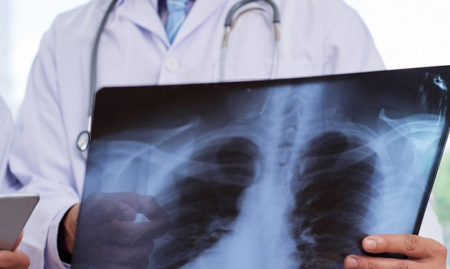 Врач рассказал о повторной пневмонии после коронавируса
