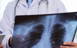 Врач рассказал о повторной пневмонии после коронавируса