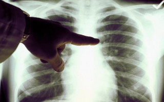 У инфицированного штаммом «Омикрон» выявили опасный недуг