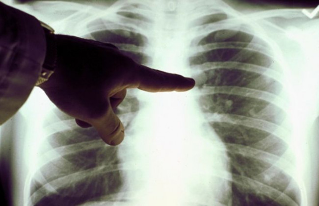 У инфицированного штаммом «Омикрон» выявили опасный недуг