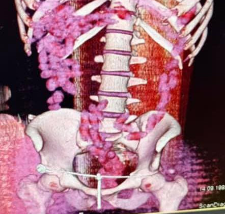 Близько 1 кг кокаїну у власному організмі: на Черкащині іноземець оригінально перевозив контрабанду