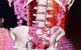Близько 1 кг кокаїну у власному організмі: на Черкащині іноземець оригінально перевозив контрабанду