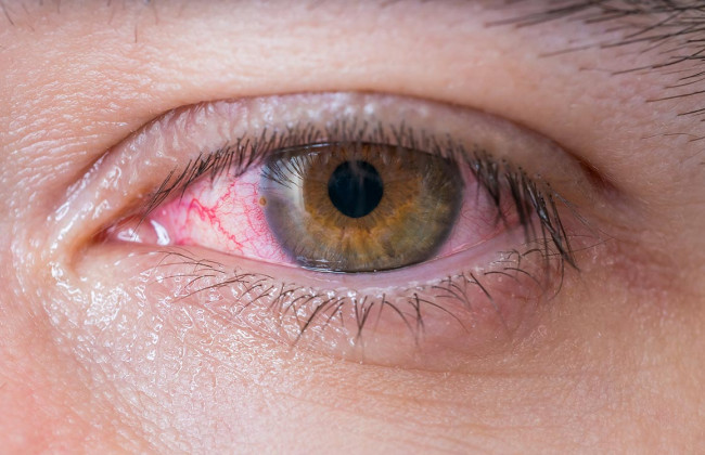 Врачи назвали очень редкий симптом коронавируса