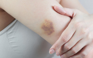 У пациентов с коронавирусом могут появиться синяки на теле: в чем опасность