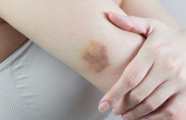 У пациентов с коронавирусом могут появиться синяки на теле: в чем опасность