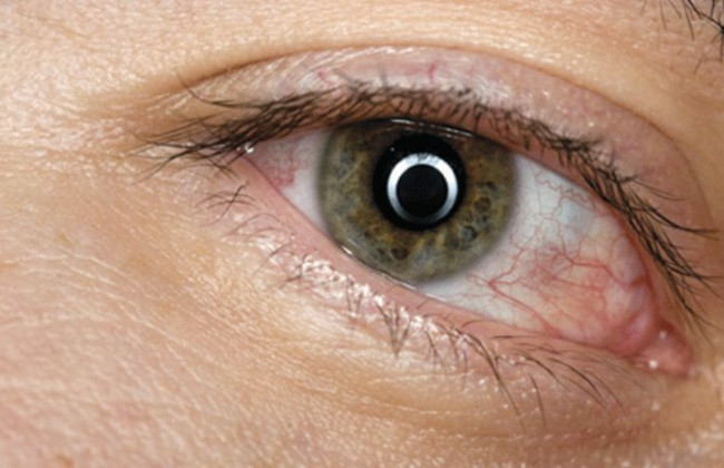 Поражает глаза: назвали странный симптом штамма «Омикрон»