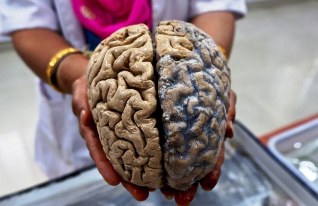 Сильнее поражает мозг: коронавирус опаснее болезни Альцгеймера