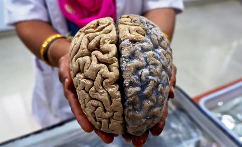 Сильнее поражает мозг: коронавирус опаснее болезни Альцгеймера