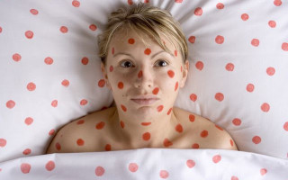 Назван симптом коронавируса, заметный на коже