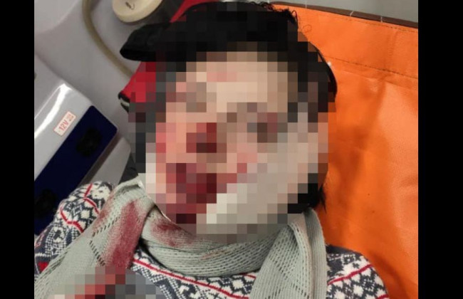 У Києві затримали чоловіка, який знівечив обличчя жінці