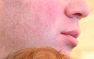 Синяя кожа, сыпь и гной: назвали кожные симптомы штамма «Омикрон»