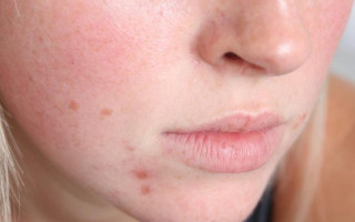 Врачи раскрыли 6 длительных симптомов штамма «Омикрон»